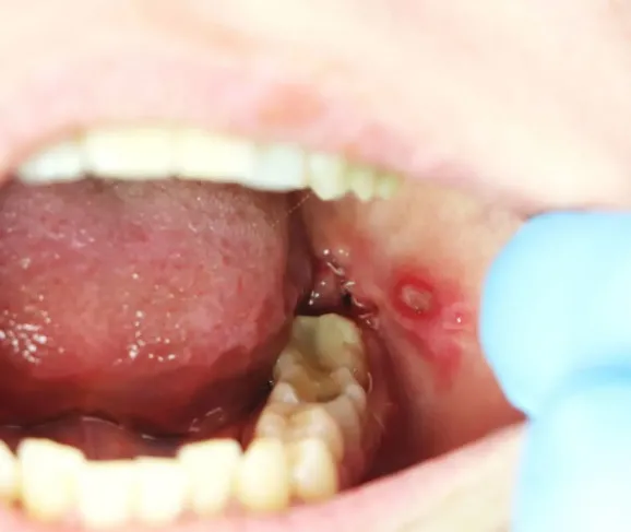 Skąd biorą się afty i jak sobie z nimi radzić?