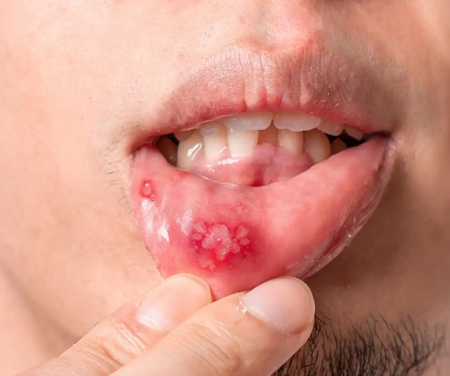 Co dokładnie wywołuje afty w jamie ustnej i jak temu zapobiegać?