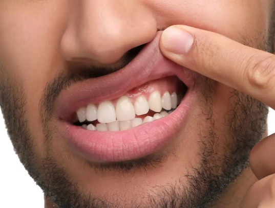 Jak skutecznie łagodzić ból i pieczenie związane z aftami?