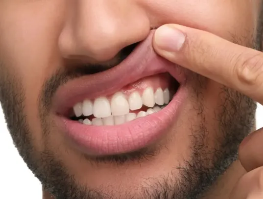 Jak skutecznie łagodzić ból i pieczenie związane z aftami?