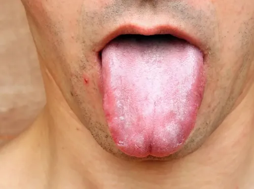 Jak radzić sobie z bólem i pieczeniem podczas pleśniawek w jamie ustnej?